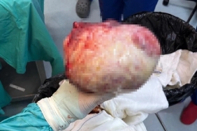 Amasya'da Kadının Şişen Karnından 6 Kiloluk Kitle Çıktı