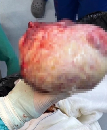 Amasya'da Kadının Şişen Karnından 6 Kiloluk Kitle Çıktı