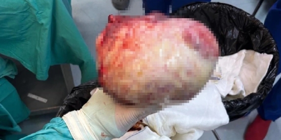 Amasya'da Kadının Şişen Karnından 6 Kiloluk Kitle Çıktı